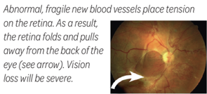 abnormal fragile new blood vessels