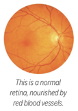 diabetic retinopathy normal retina