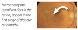 Diabetic retinopathy stage1