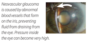 In neovascular glaucoma, abnormal vessels form on the iris