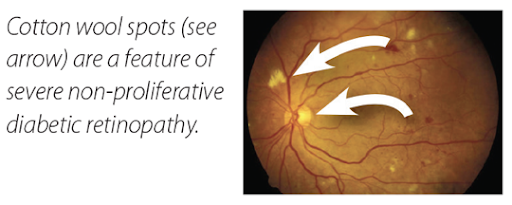 non proliferative diabetic retinopathy